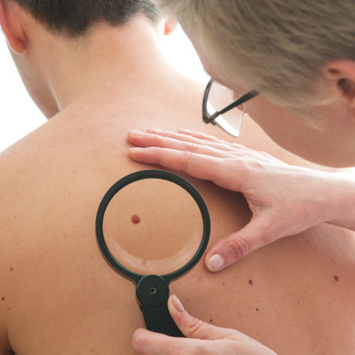 Dermatologist examines a mole of male patient